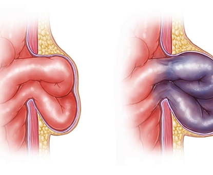 Triệu chứng nào cho thấy thoát vị bẹn có thể đang gây biến chứng nghẹt?